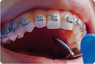 What to Expect During Your First Orthodontic Consultation in Abu Dhabi