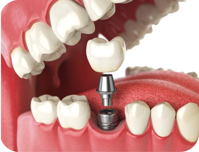 Dental implants in Abu Dhabi at California Medical Center