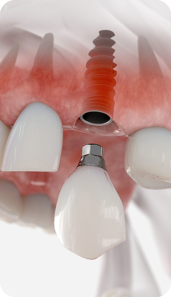 Dental implants in Abu Dhabi at California Medical Center