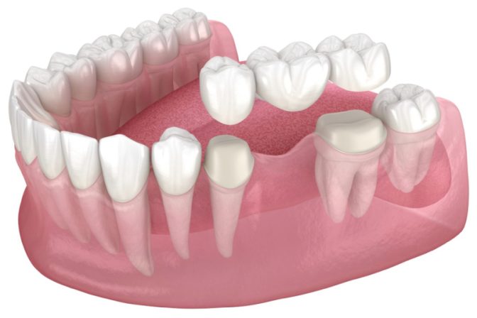 Best Options for Missing Teeth Replacement in Abu Dhabi