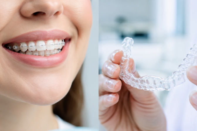 Braces vs Invisalign in Abu Dhabi: Which Is Better for You?